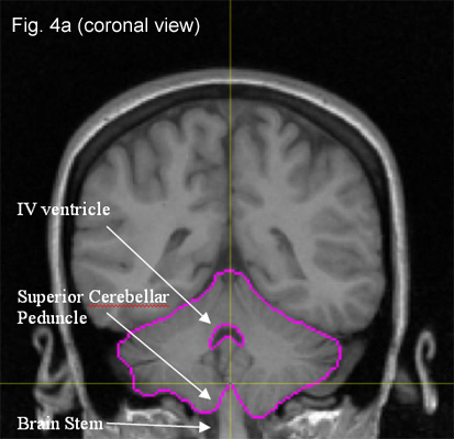 cerebellar vermis sagittal view
