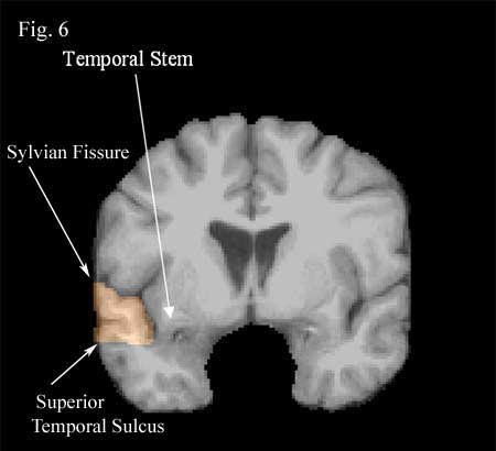 middle temporal sulcus